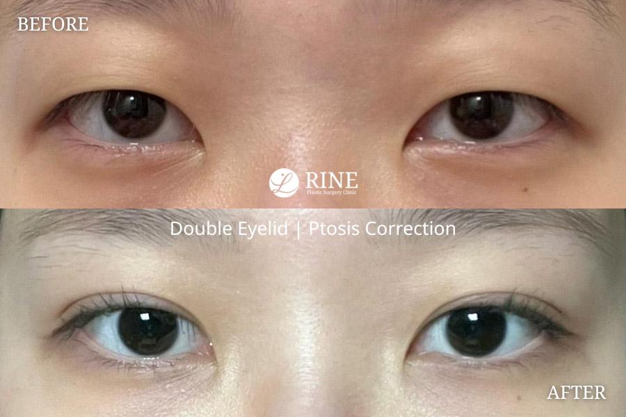 Double Eyelid ptosis correction