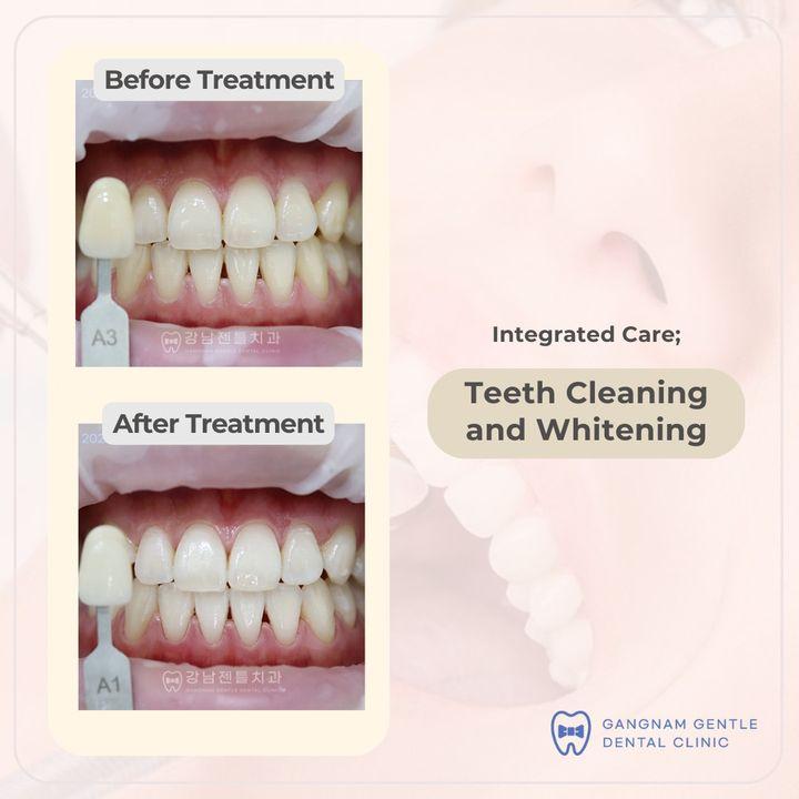 Teeth Cleaning
