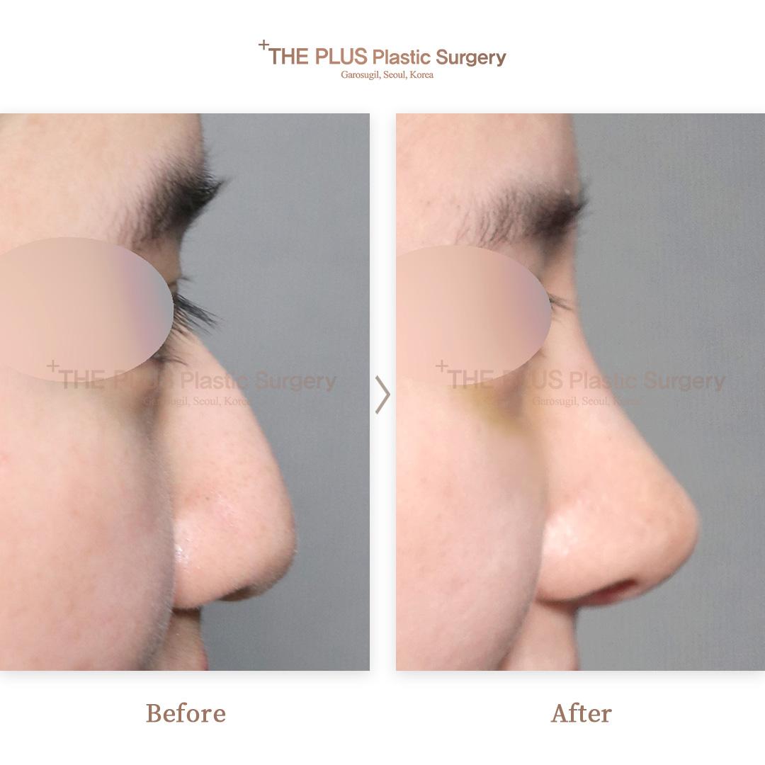 Primary Rhinoplasty & Hump Correction & 3D Implant & Rib Cartilage Shaving & Ear Cartilage & Septal Cartilage
