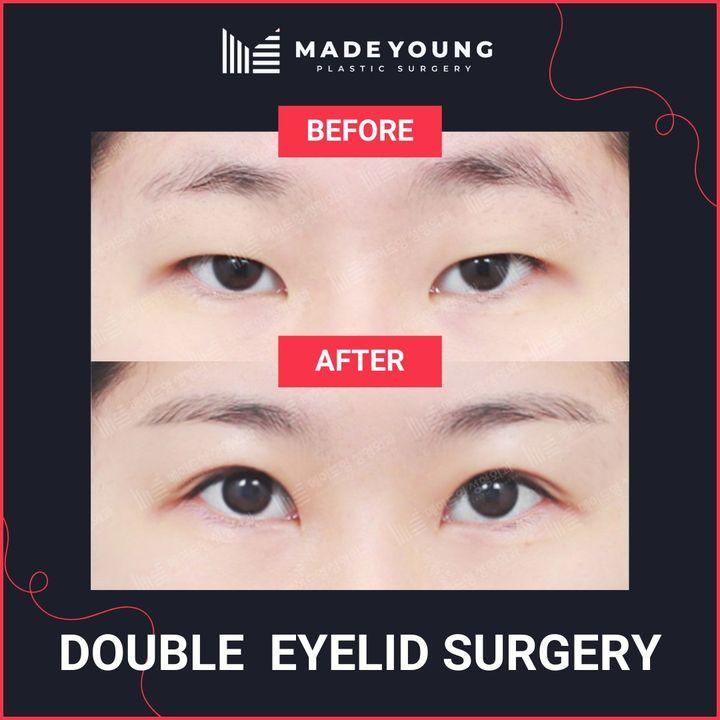 Unsere Augen sind ein Spiegel der Individualität. Entdecken Sie die Feinheiten der Augenchirurgie bei MadeYoung. Verwirklichen Sie die Vision eines selbstbewussteren Ichs. #MadeYoungEyes