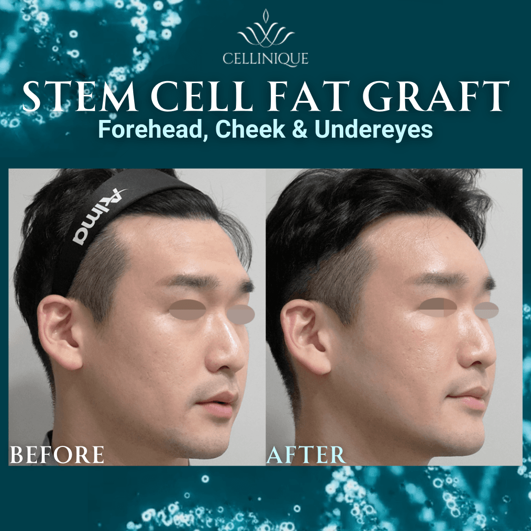 Cellinique Clinic before and after image