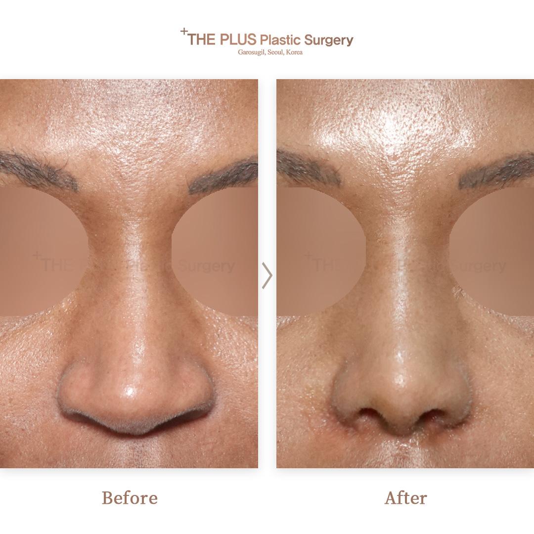 2nd Revision Rhinoplasty & Tip Correction & Alar Reduction