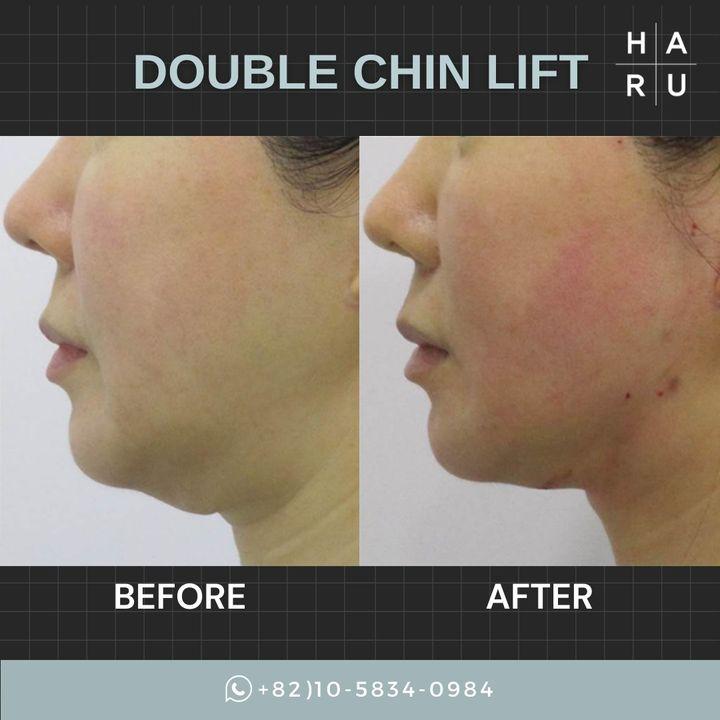 double chin tightening korea