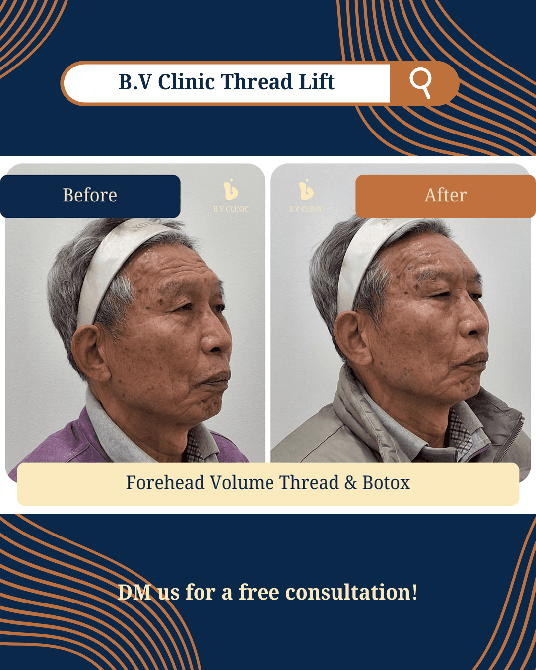 Stirn-Fadenlifting, Stirn-Botox