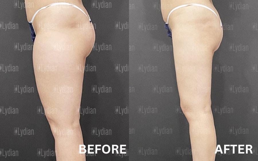 lipo c injection thigh Inner, Outer, and Anterior Liposuction Procedures A, C) This 39-year-old woman