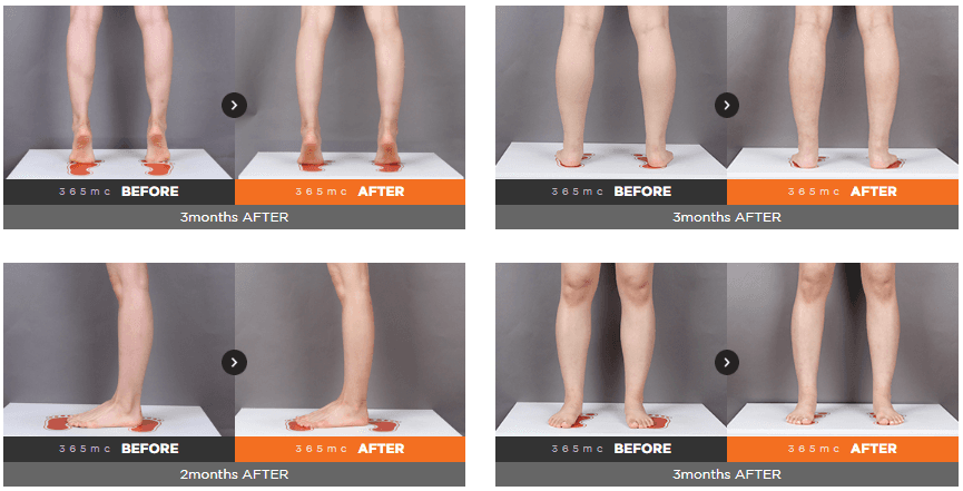 Calf Liposuction before and after