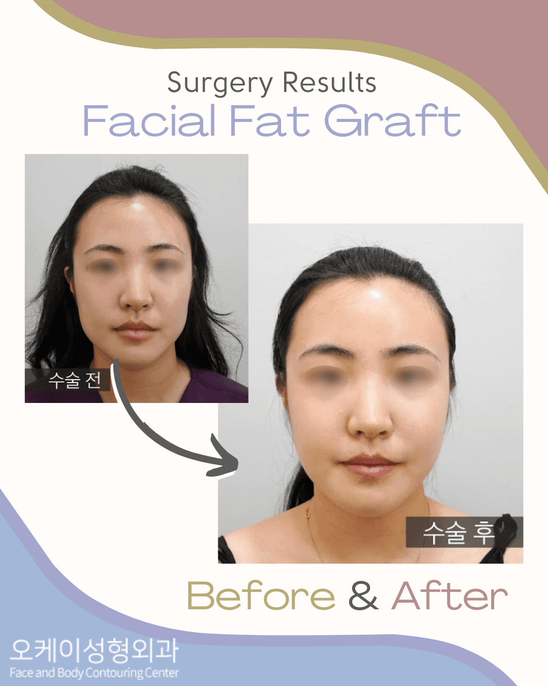 cost face fat grafting korea