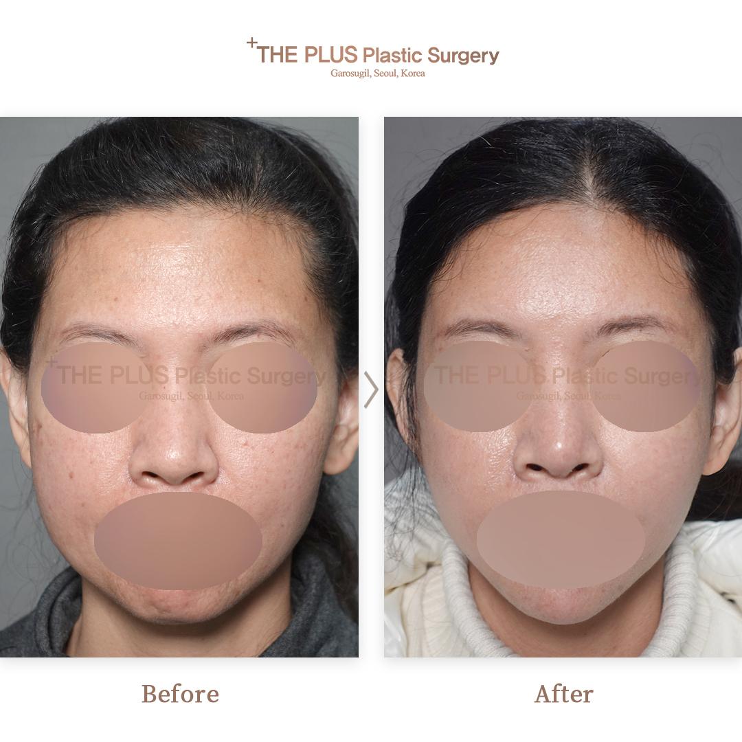 Face contouring + Thread Lifting