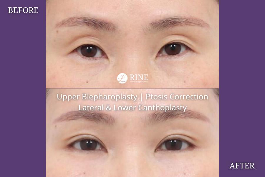 Upper Blepharoplasty ptosis correction lateral lower canthoplasty