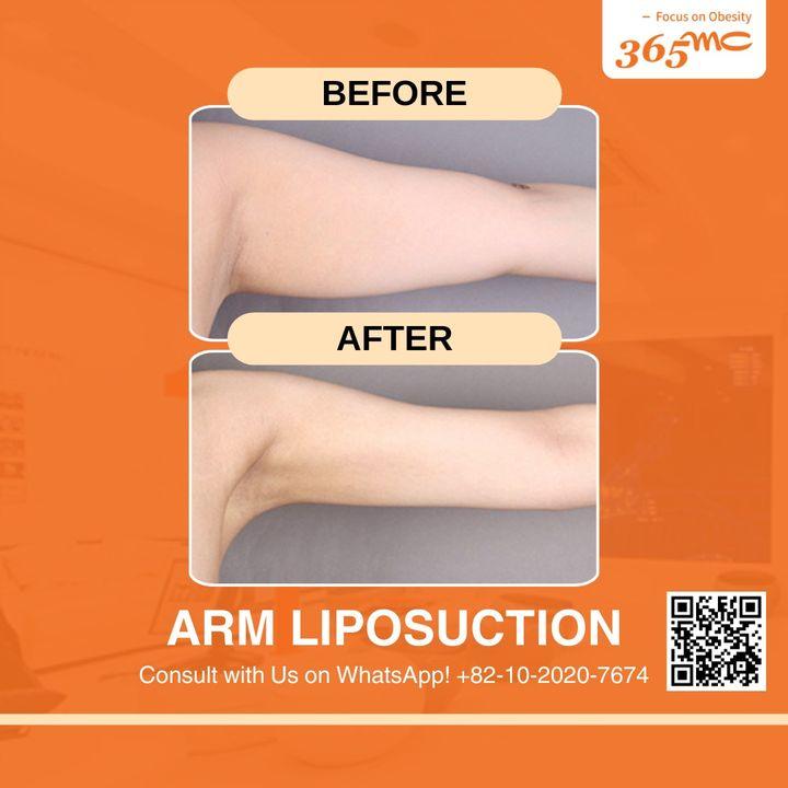 Before and After Arm Liposuction