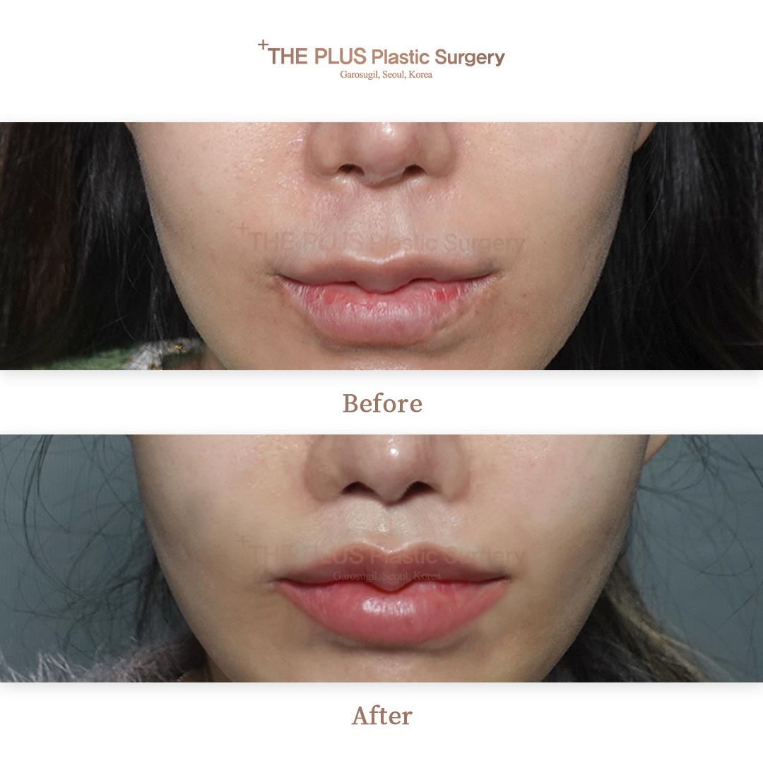 THEPLUS Plastic Surgery before and after image