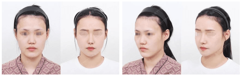 cost square jaw surgery korea