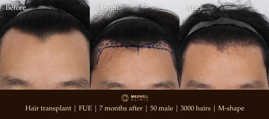 Before and After Hair Transplant