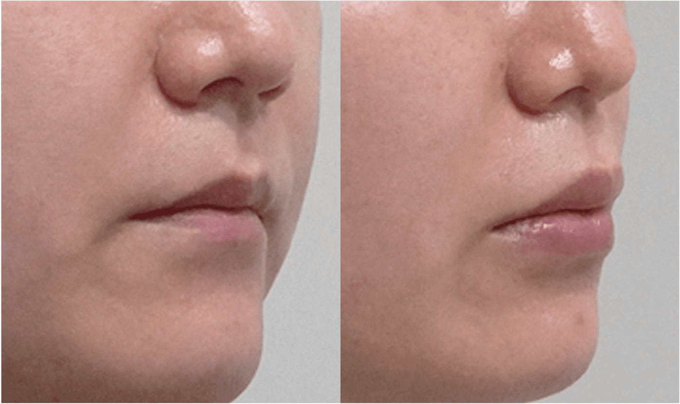 cellreand-female-stem-cell-fat-grafting-lip-03.png