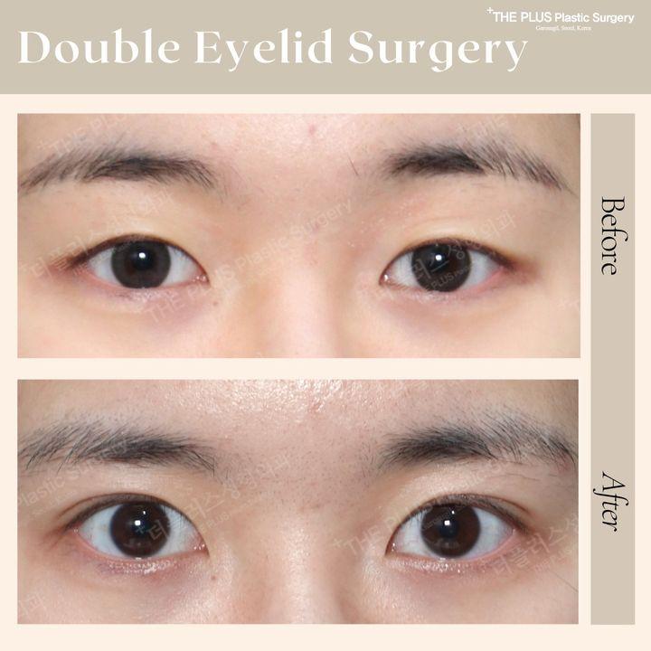address heavy upper eyelids korea