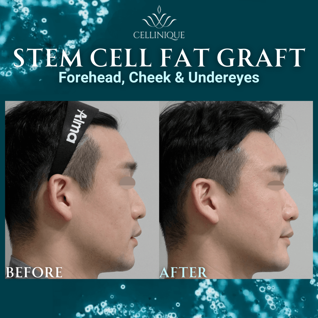stem cell facial korea