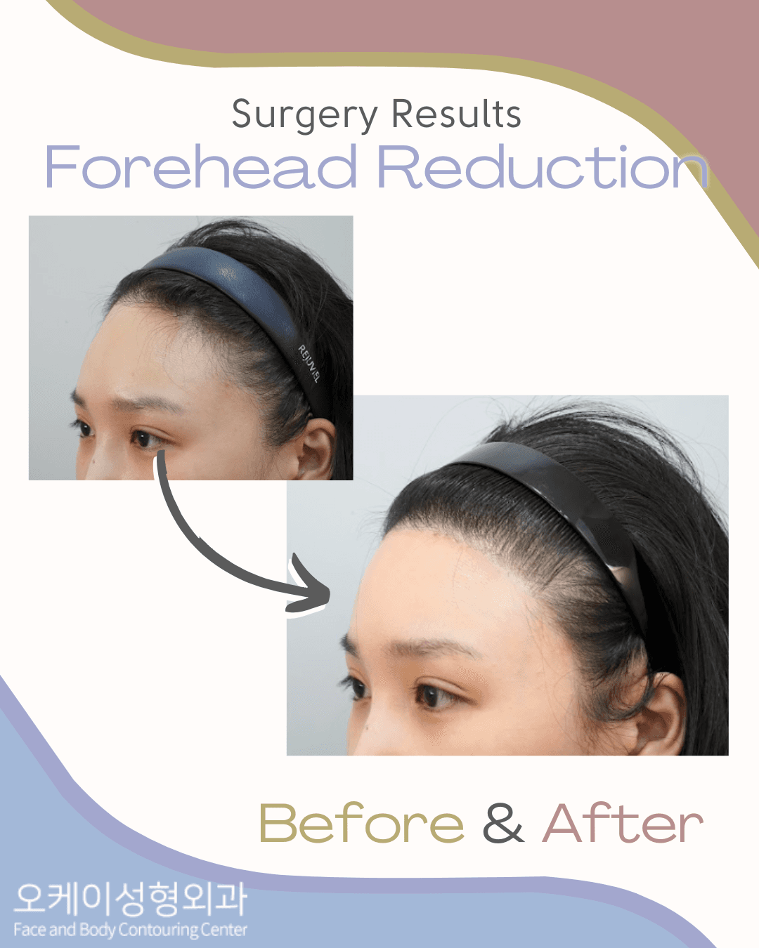 cost forehead reduction korea