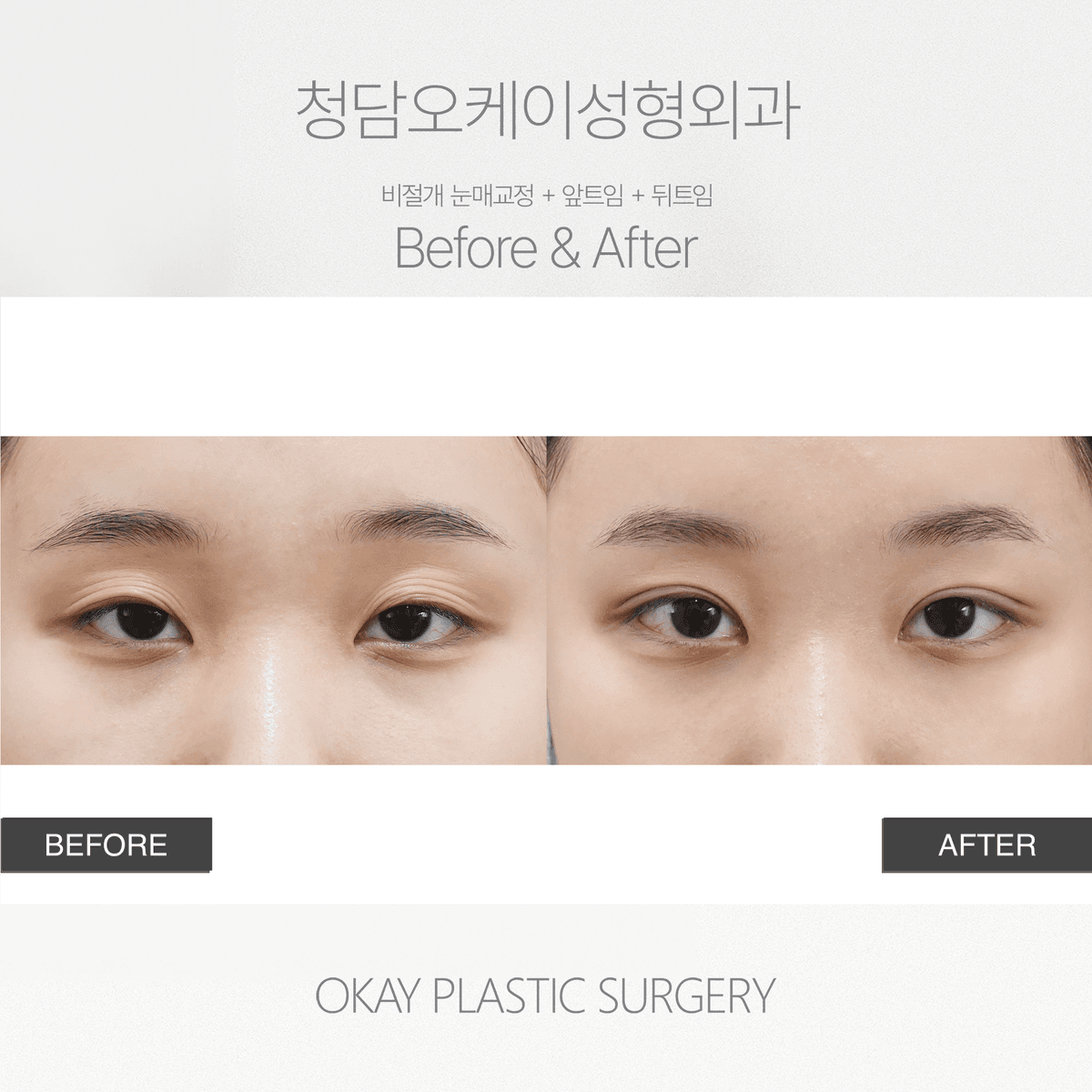Before and After Ptosis Correction