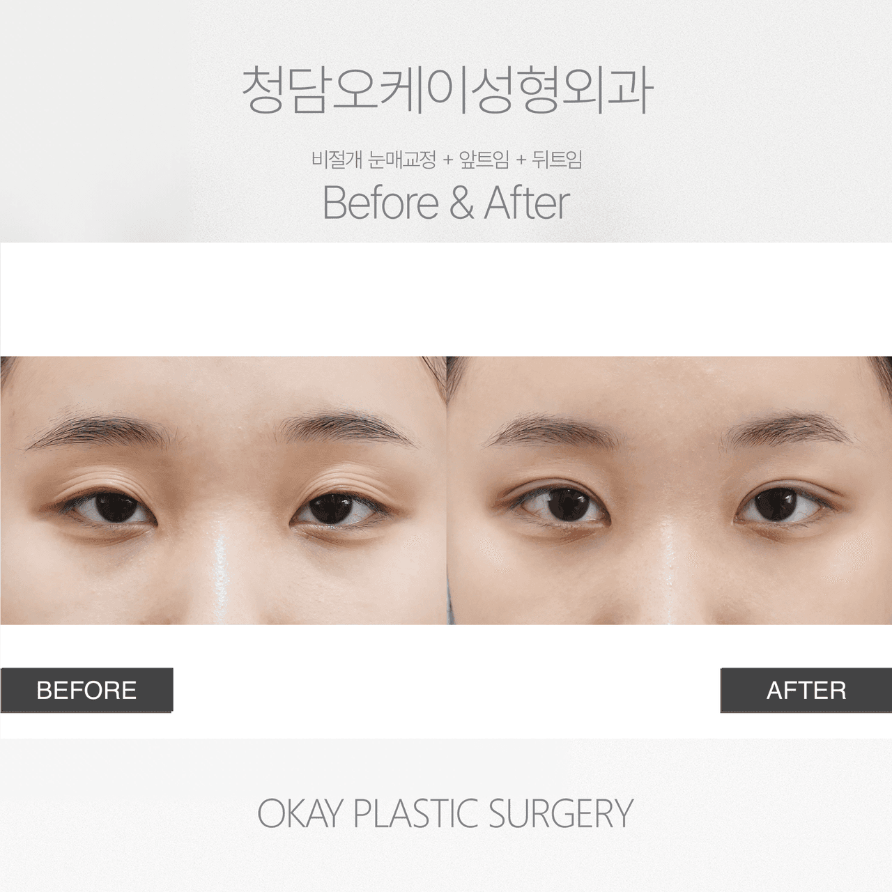 Before and After Ptosis Correction