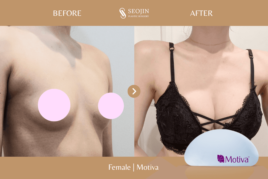 Before and After Breast Augmentation