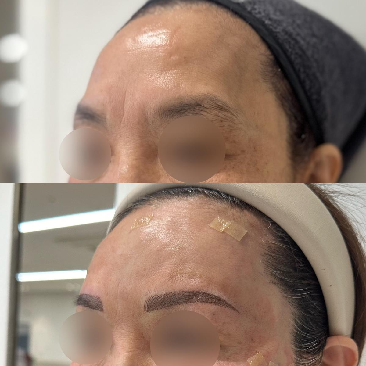 Before and After Forehead Filler
