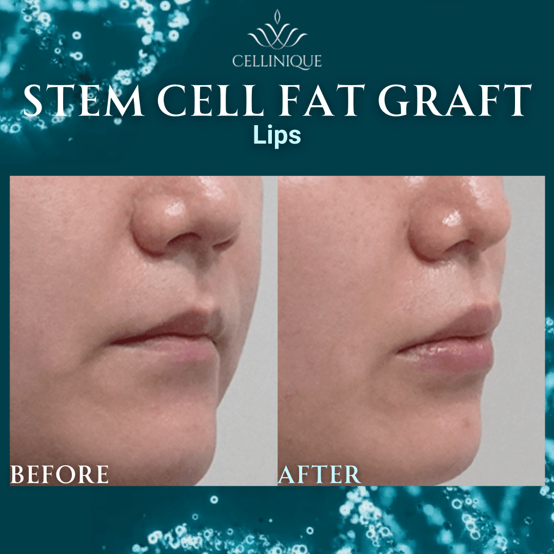 Cellinique Clinic before and after image