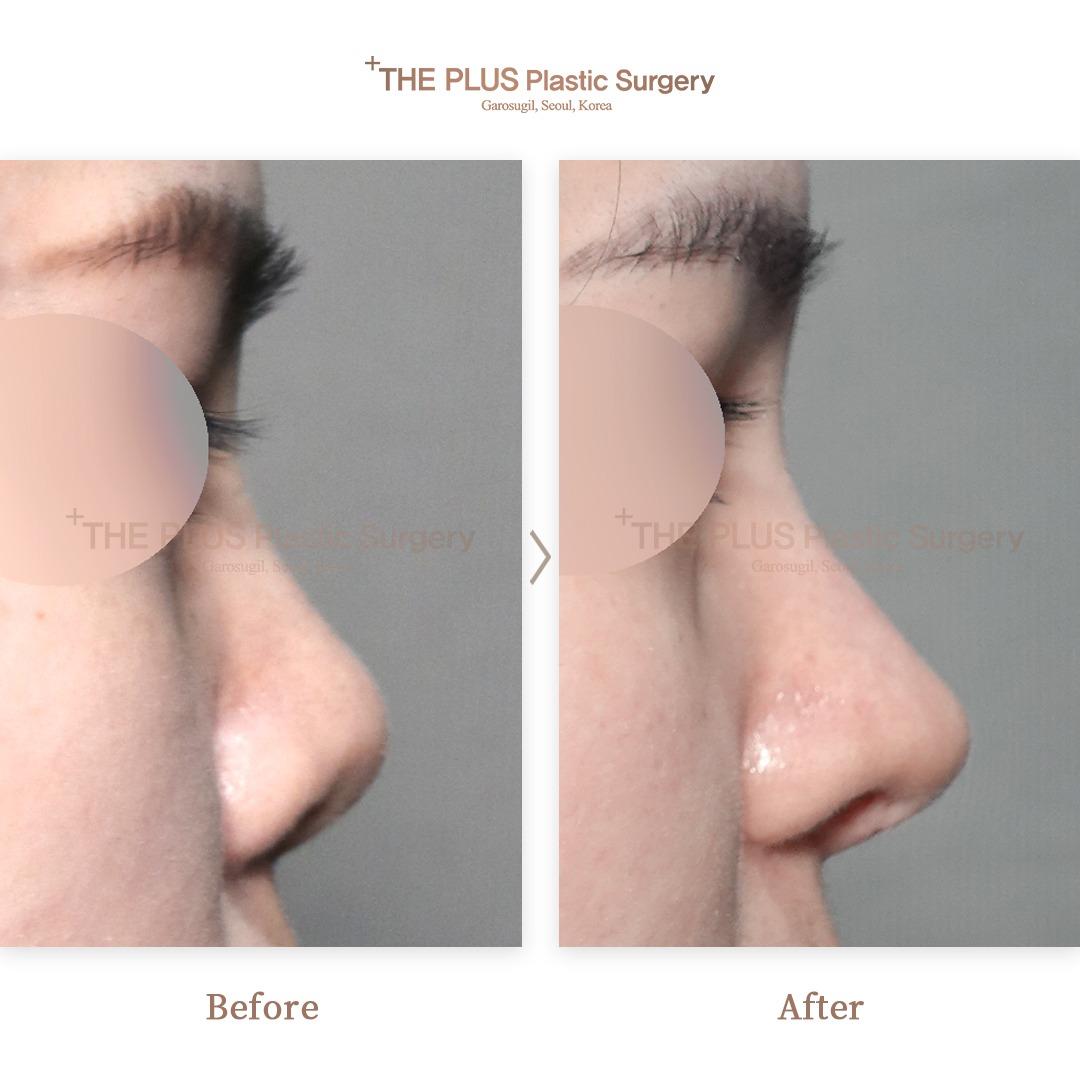 THEPLUS Plastic Surgery before and after image