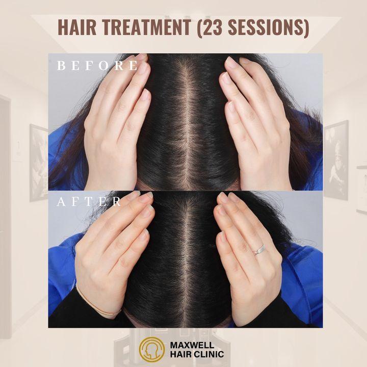 cost hair loss treatment korea