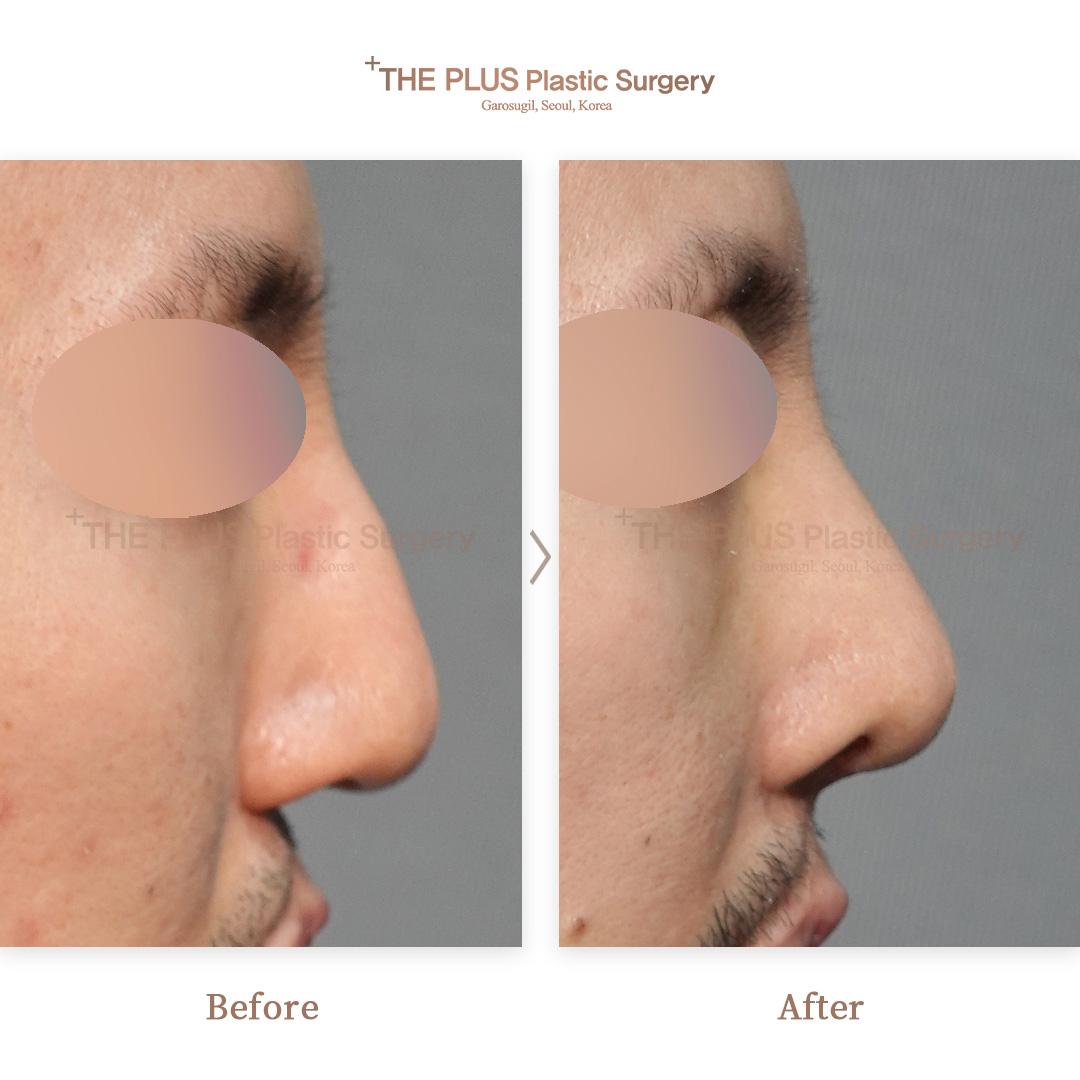 Before and After Rhinoplasty