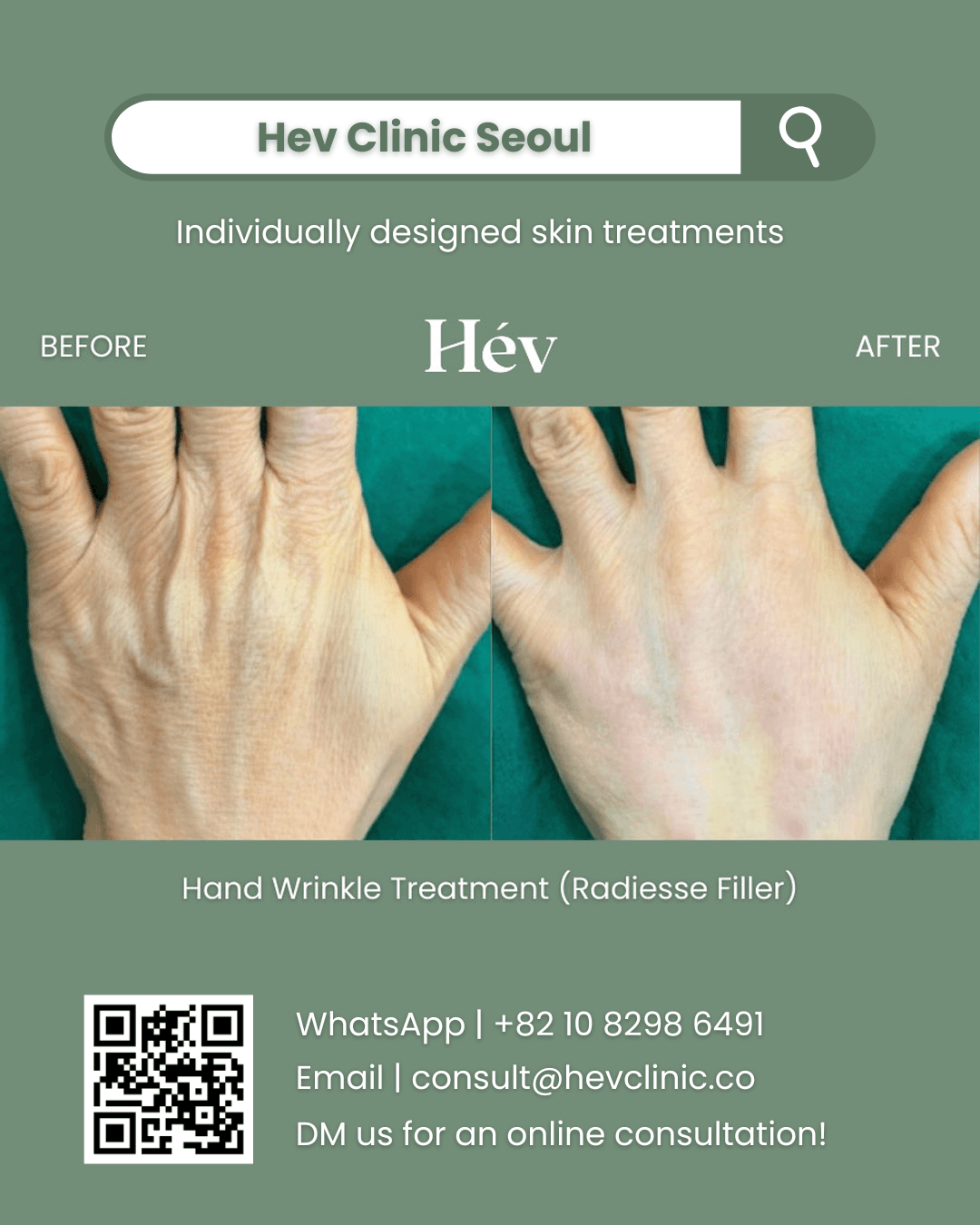 Hand Wrinkle Treatment, Radiesse Filler