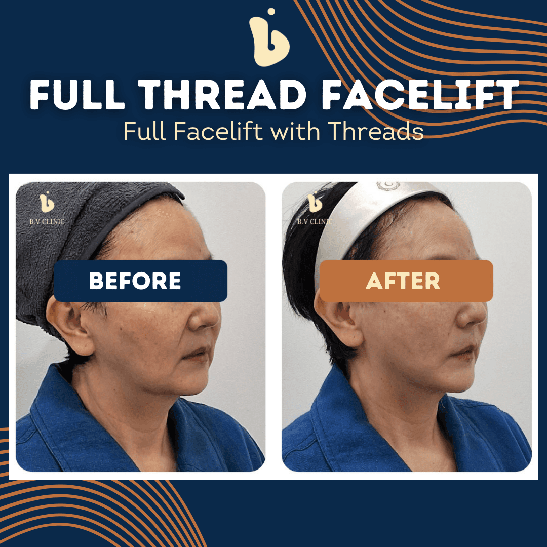 B.V Clinic before and after image