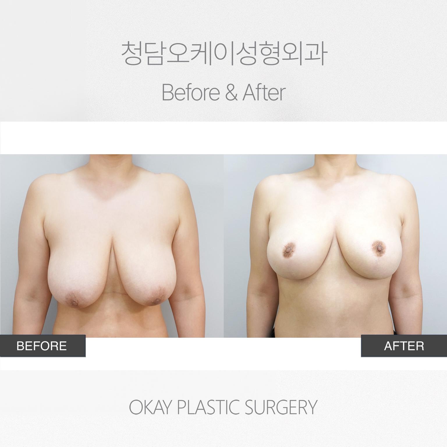 Breast Lift with Areolar Incision Method
