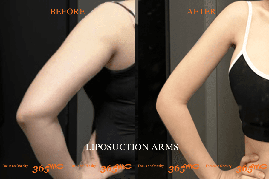 Before and After Arm Liposuction