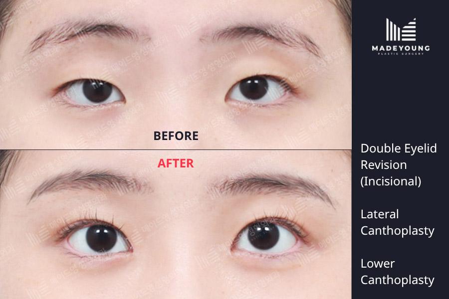 Eyelid revision incisional lateral canthoplasty lower canthoplasty