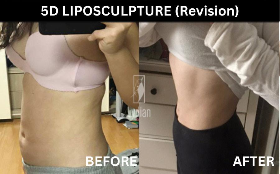 Vorher-Nachher-Bild der Lydian Plastic Surgery Clinic