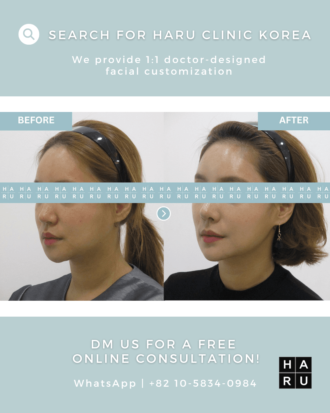 Chin Filler, Chin Botox, Fat Dissolving Injection