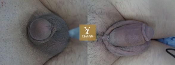 Comprehensive Penile Enhancement at Yezak Penis Enlargement + Penis Lengthening + Glans Enlargement + Premature Ejaculation Treatment + Erectile Dysfunction Treatment