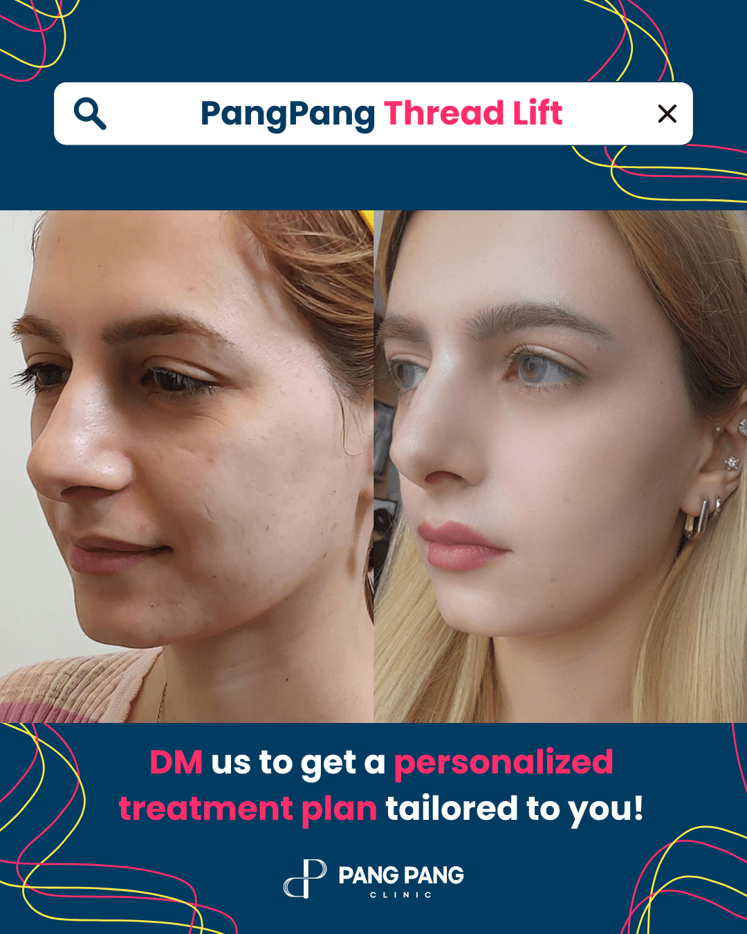 Thread Lift, Eyebrow Thread Lift, Forehead Thread Lift