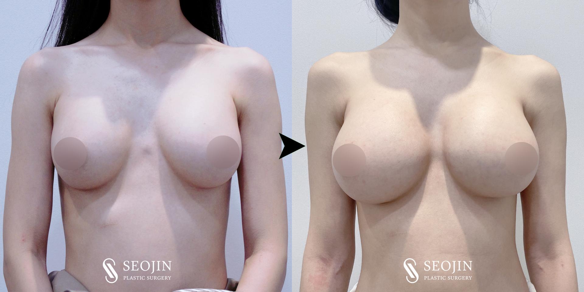 cost revision breast surgery korea