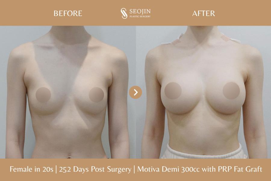 Seojin Plastic Surgery Clinic before and after image