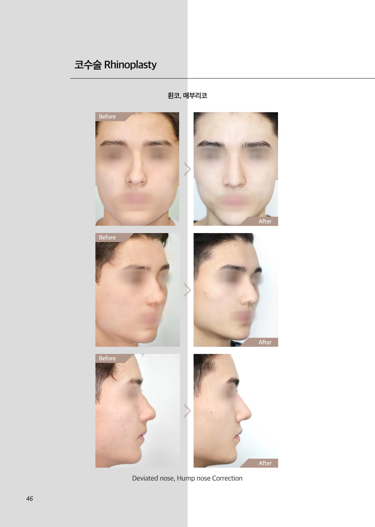 THEPLUS Plastic Surgery before and after image