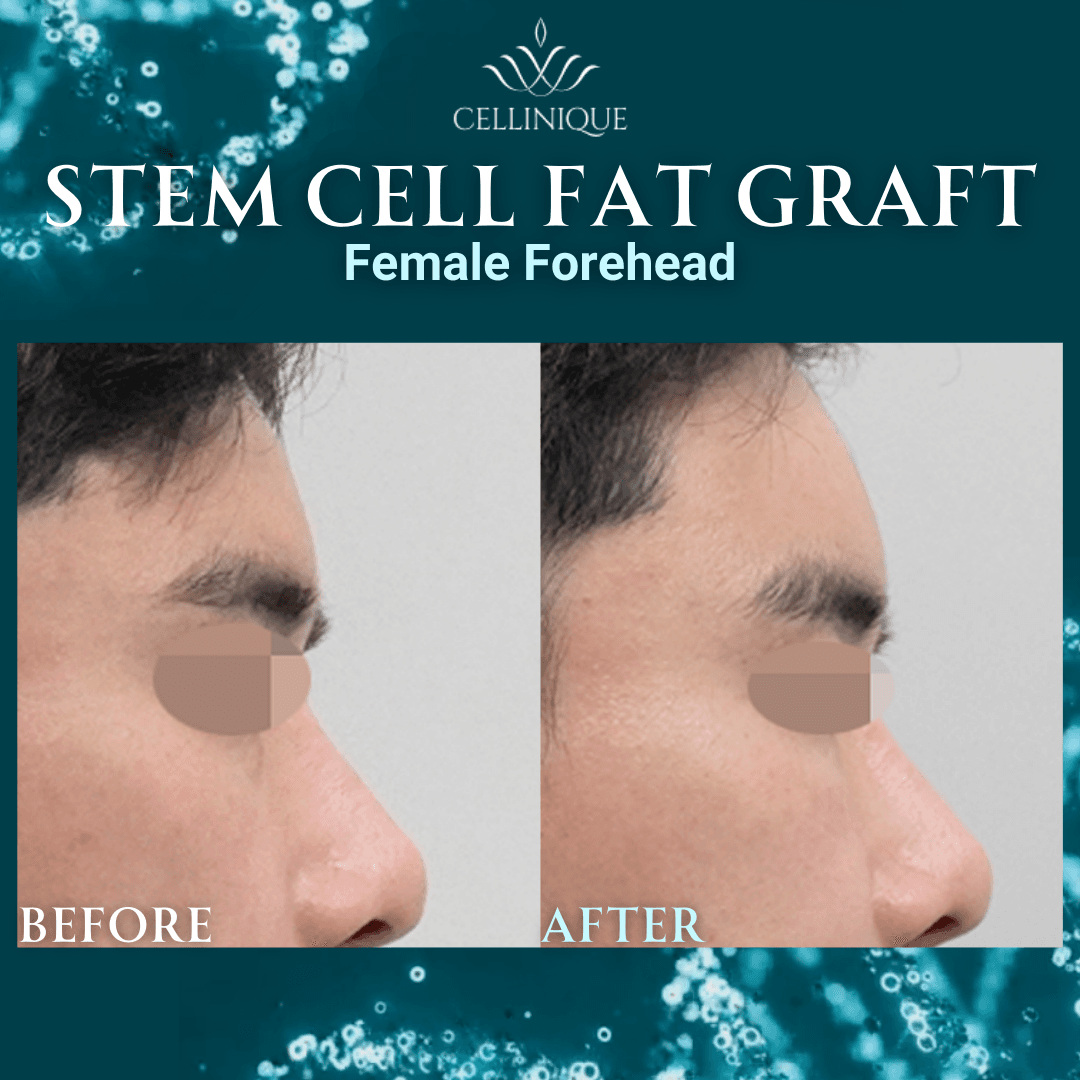 Cellinique Clinic before and after image