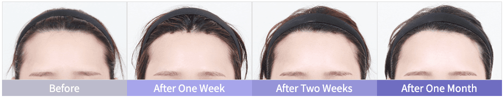 Before and After Forehead Lift