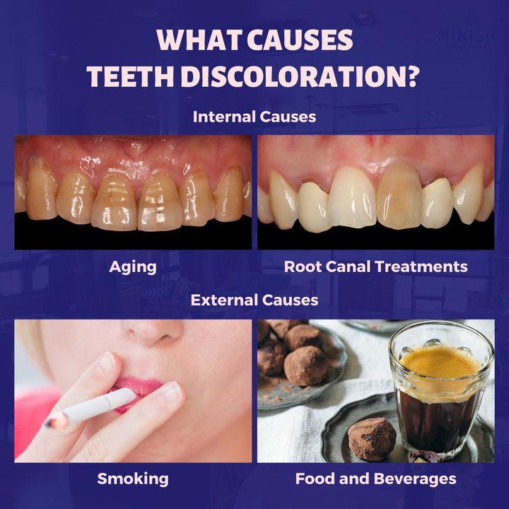 Teeth Whitening, Teeth Cleaning