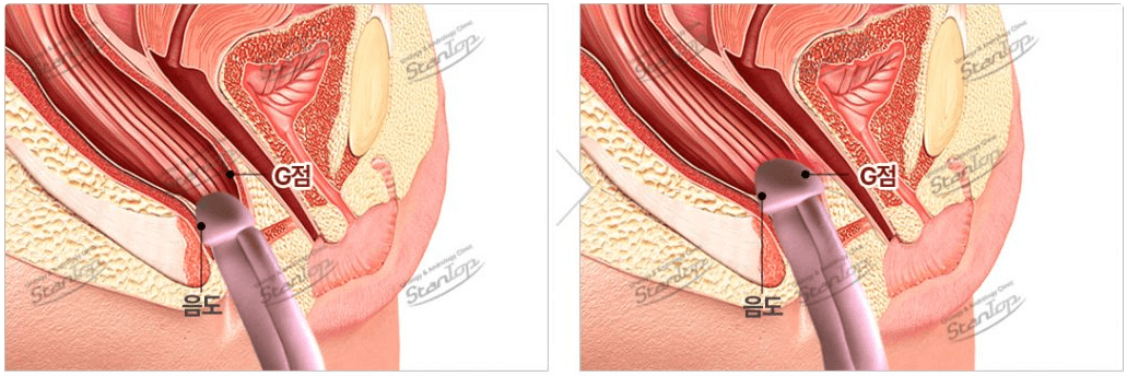 Penis Lengthening