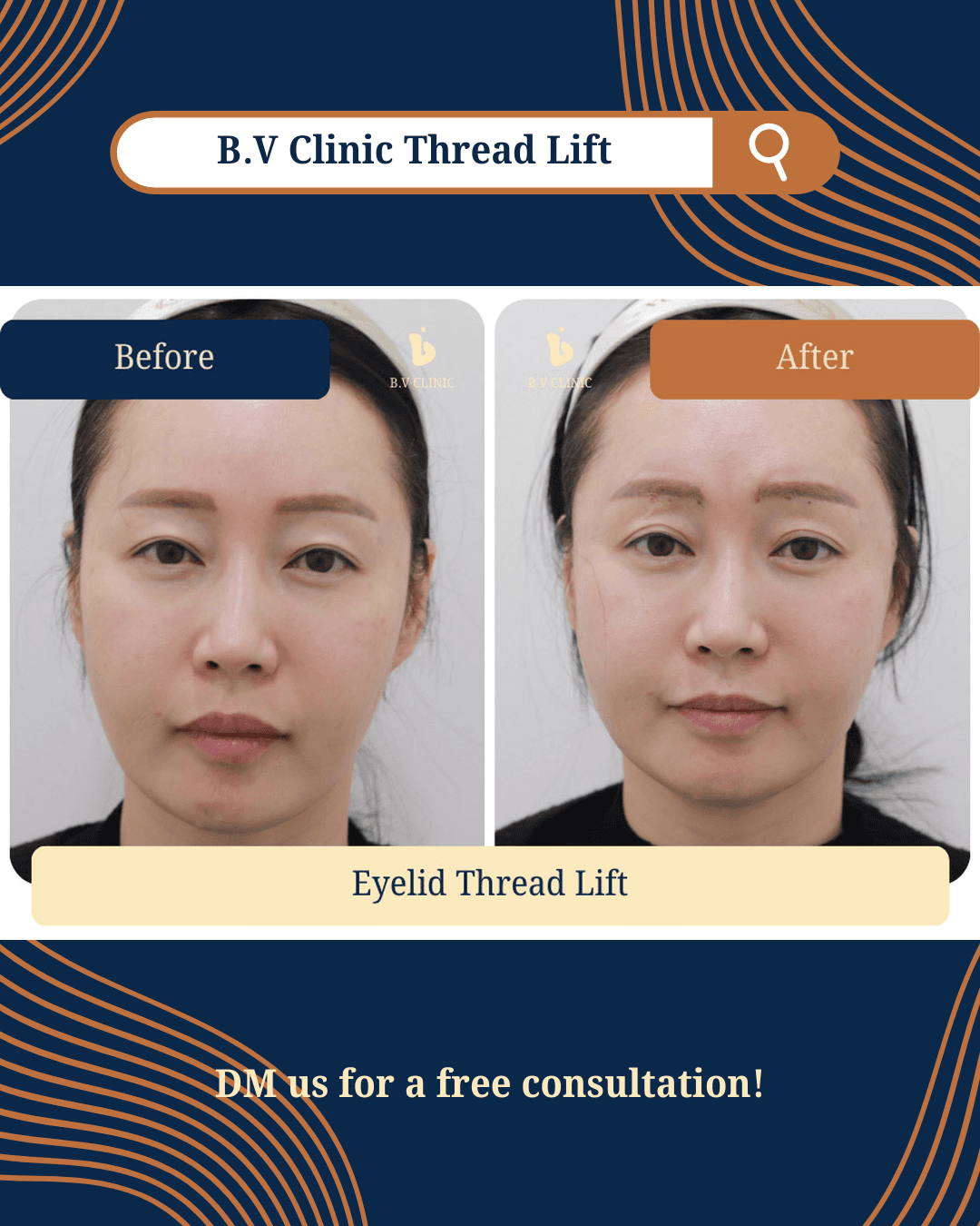 Eye Thread Lift