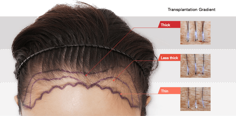 Hairline Correction, Hair Transplant