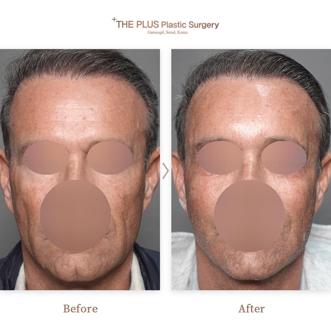 Before and After Face Fat Grafting