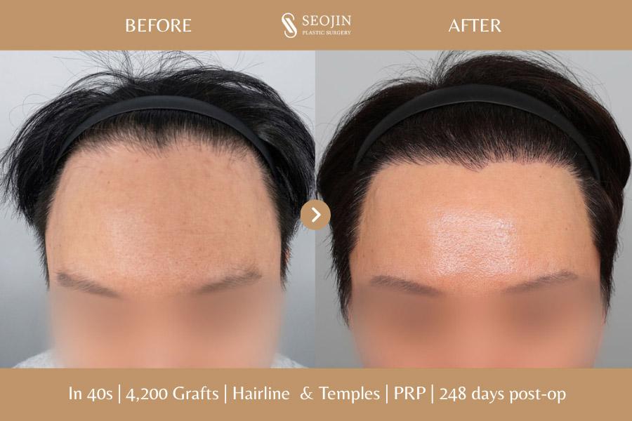 Before and After Hair Transplant