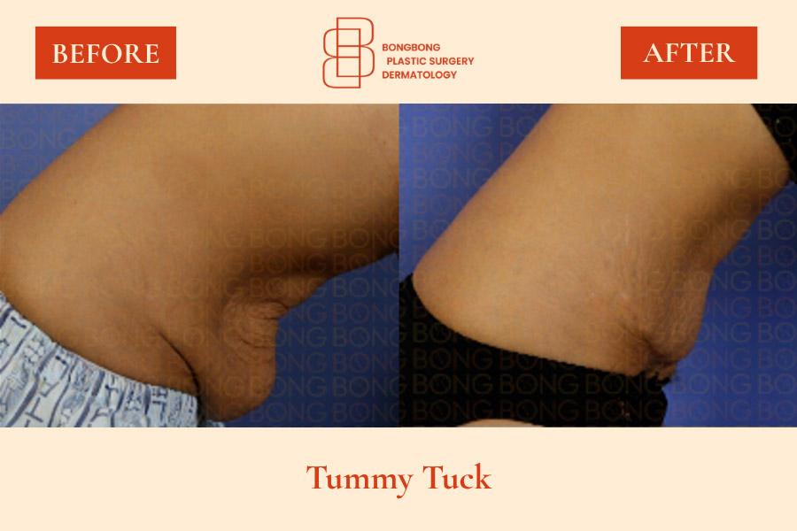 BongBong Plastic Surgery Dermatology before and after image
